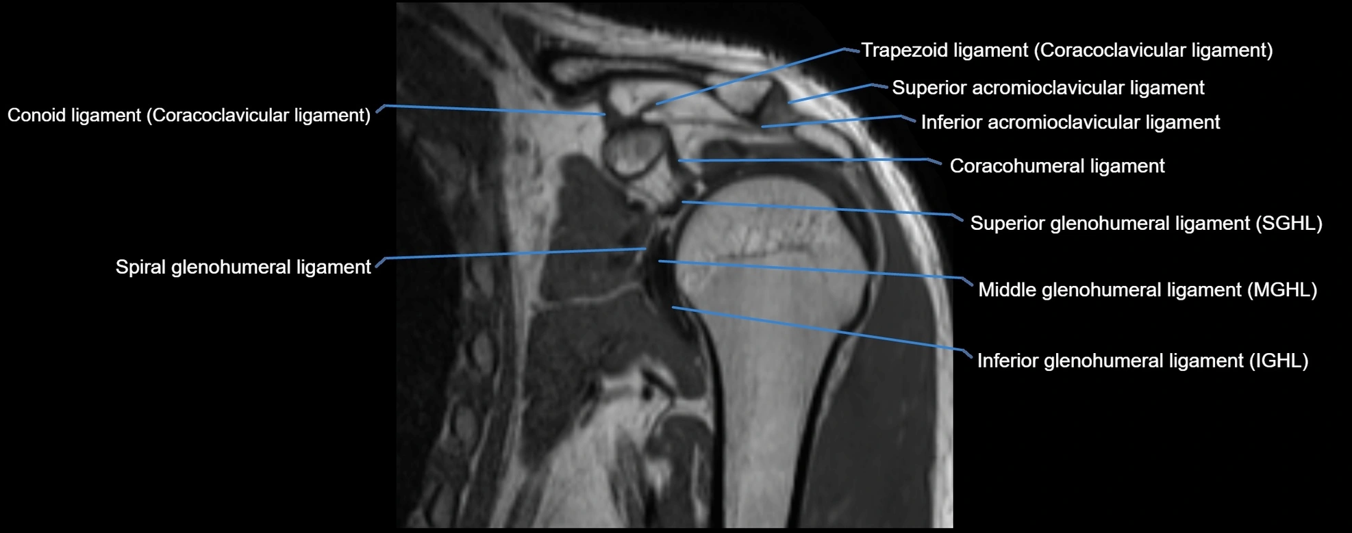 shoulder ligments coronal  cross sectional anatomy 3T MRI AI enhanced radiology image -img-00001-00019.webp